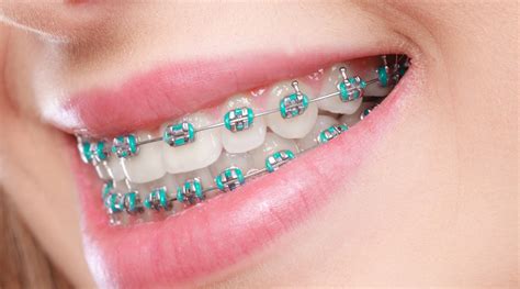 metal bracket orthodontics|best metal braces for teeth.